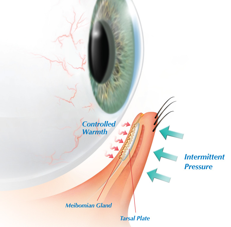 Dry Eye Philadelphia Treatment for Severe Dry Eye in ...