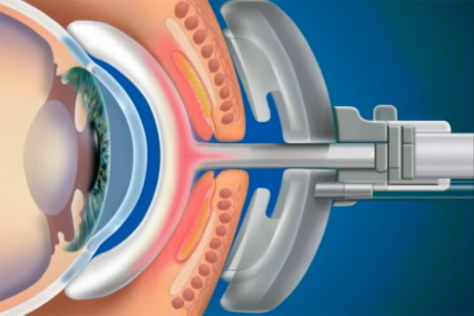 Lipiflow Treatment Animation For Dry Eye Dry Eye Philadelphia 